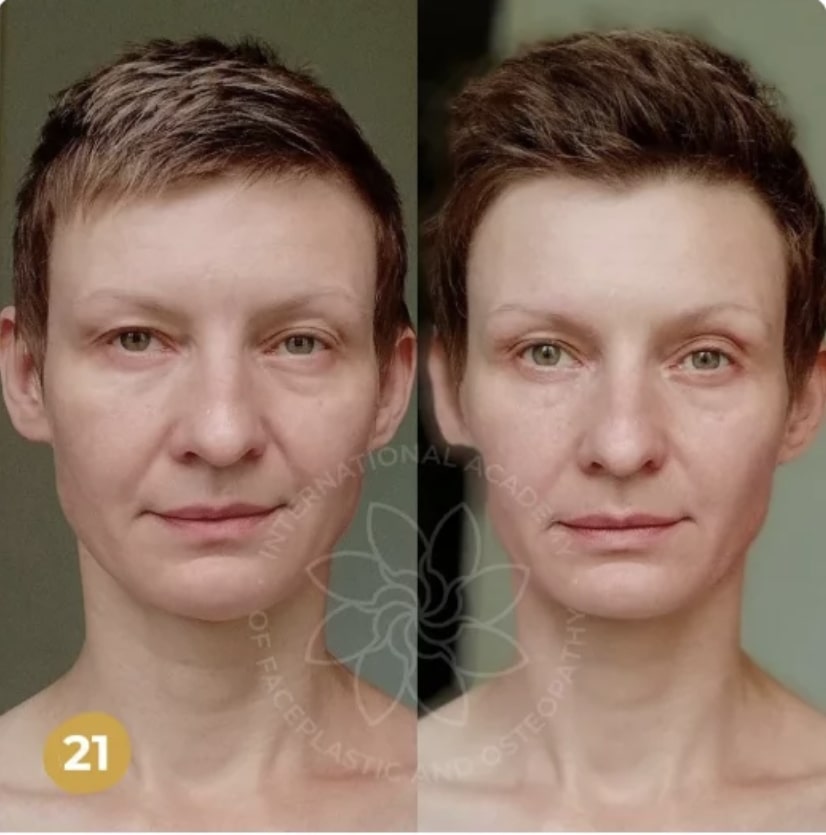Results after training :: FACEPLASTIC AND OSTEOPATHY - FZCO