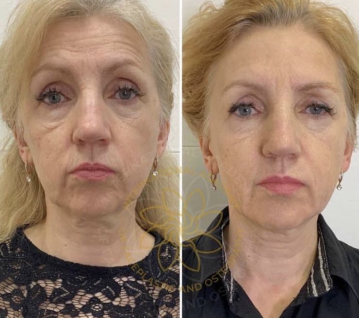 Results after training :: FACEPLASTIC AND OSTEOPATHY - FZCO