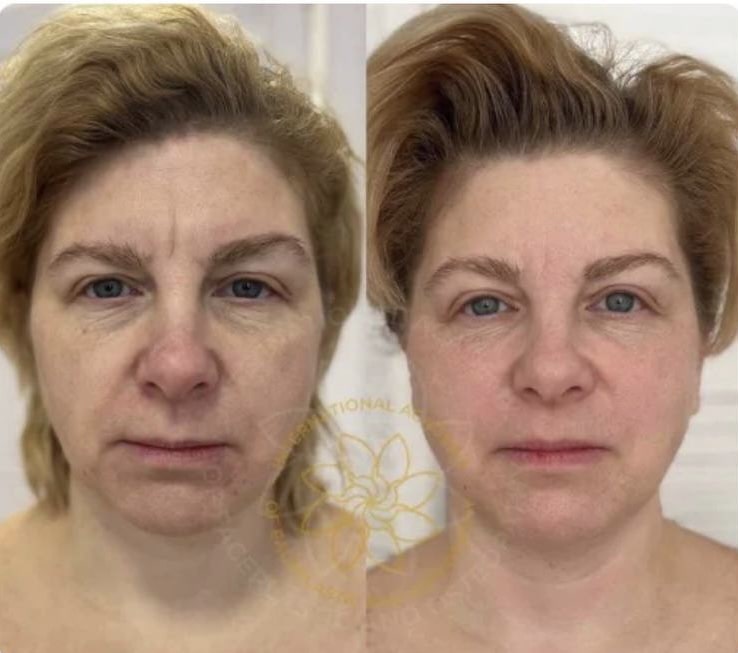 Results after training :: FACEPLASTIC AND OSTEOPATHY - FZCO